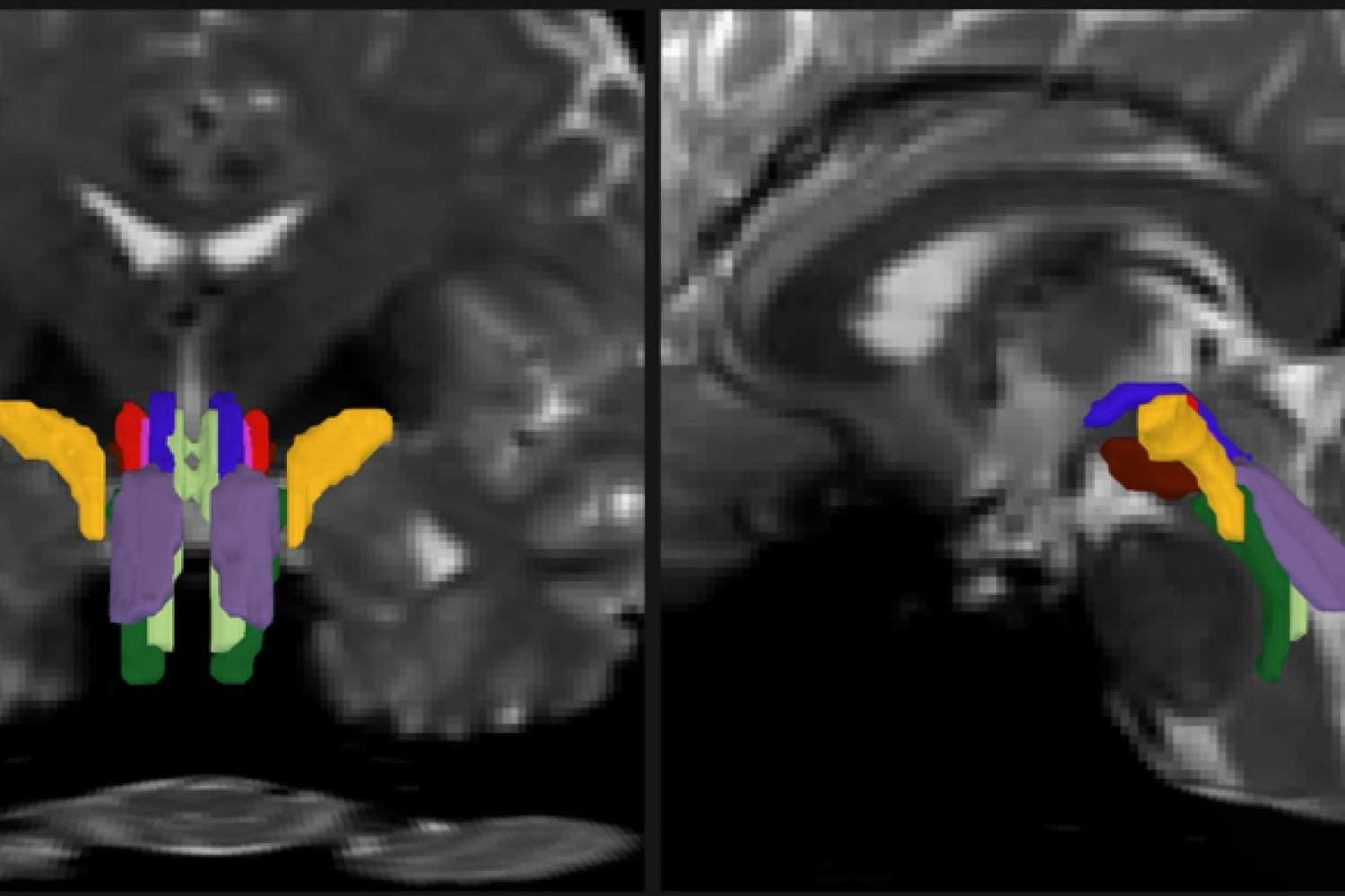 AI algorithm enables tracking of vital white matter pathways AI algorithm enables tracking of vital white matter pathways